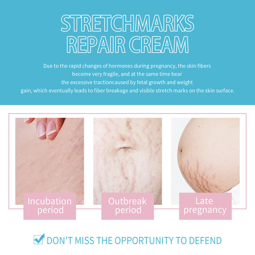 Stretch Marks Repair Cream, Moisturizing And Repairing Skin Lighten Pregnancy Scars Smooth Skin Care Cream