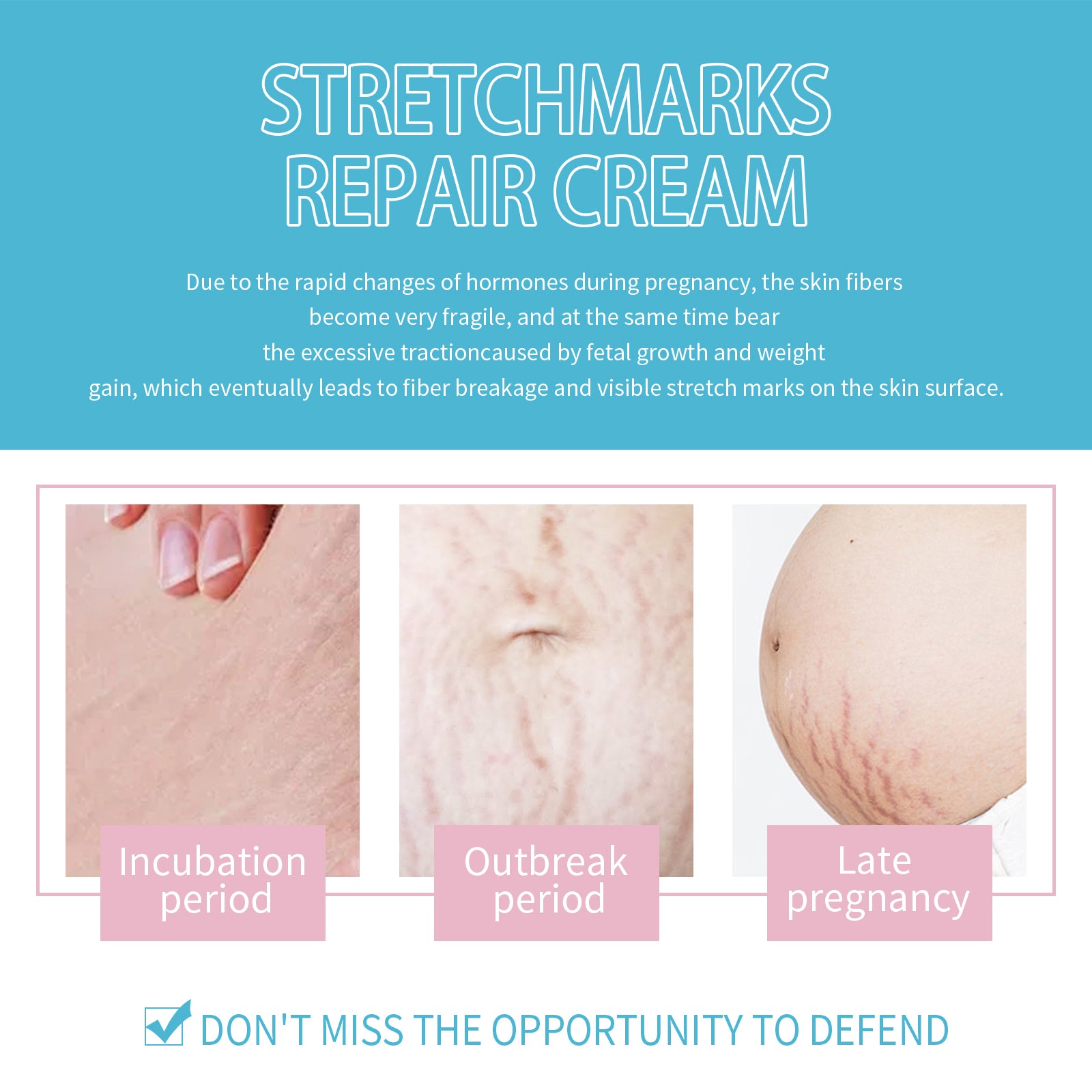 Stretch Marks Repair Cream, Moisturizing And Repairing Skin Lighten Pregnancy Scars Smooth Skin Care Cream