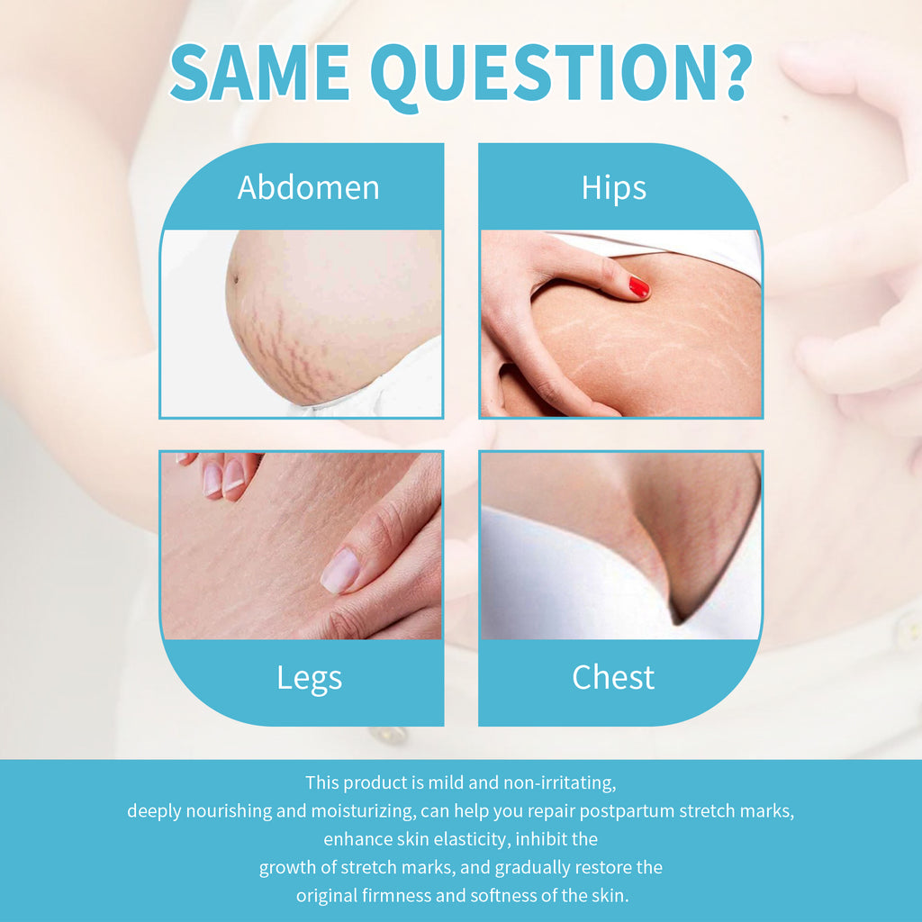 Stretch Marks Repair Cream, Moisturizing And Repairing Skin Lighten Pregnancy Scars Smooth Skin Care Cream