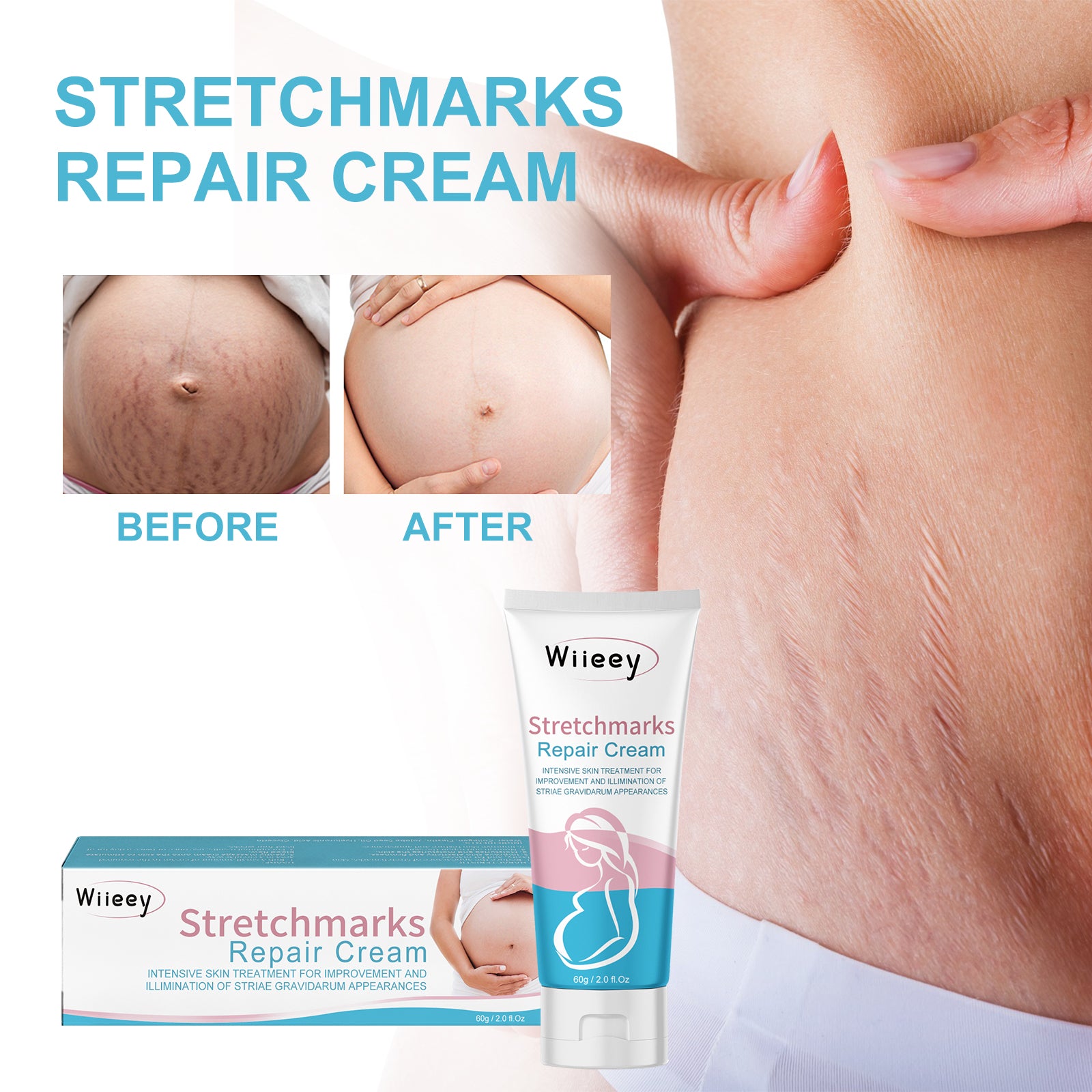 Stretch Marks Repair Cream, Moisturizing And Repairing Skin Lighten Pregnancy Scars Smooth Skin Care Cream